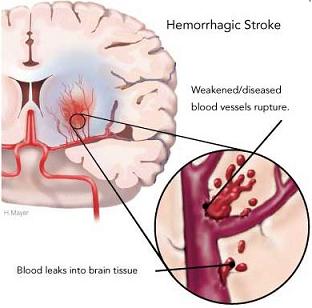 Health-Hemorrhagic-stroke-STR-2